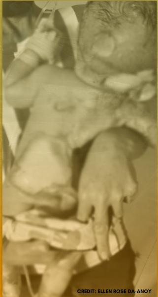 Lapsag nga nalapnos ang panit sa sunog sa Passi City kritikal sa ospital tungod sa na-develop nga pneumonia