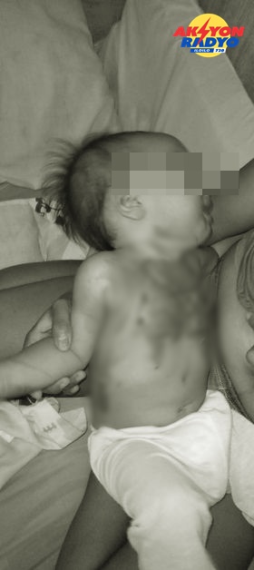 10 month-old nga bata sa Oton nalapnos ang lawas sang naulaan sang mainit nga sabaw