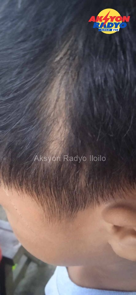 Maestra sa San Miguel, Iloilo ginreklamo nga nagpanggan-it sang estudyante rason nga napal-it ang parte sang ulo