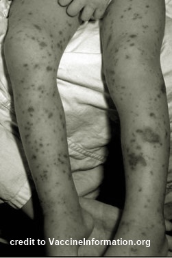 58-anyos nga pasyente sa Miagao First Aid Clinic nga suspected case ng Meningococcemia napatay